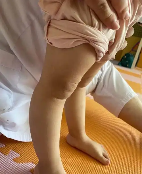 小患者女孩子,两岁五个月,因家长发现其"腿型不直""走路姿势不好看""