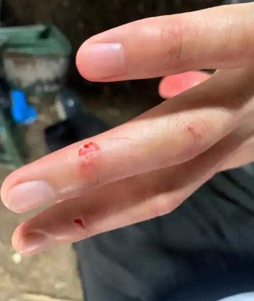 从照片来看,他的手指不过是破点表皮而已,根本算不上是上,更不用说