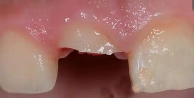 30岁牙齿多颗缺失,为何不采用连冠或all-on-4种植?