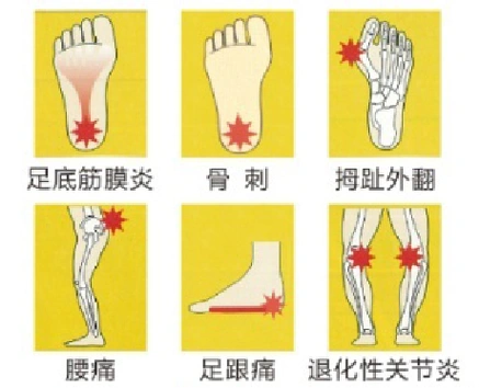 一分钟认识扁平足,扁平足的日常表现和危害有哪些
