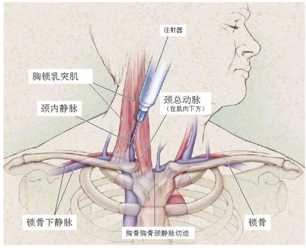 围术杂谈丨颈内静脉穿刺术