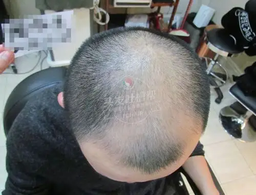 发友头顶光秃之后99的人只能用这种方式重拾满头秀发