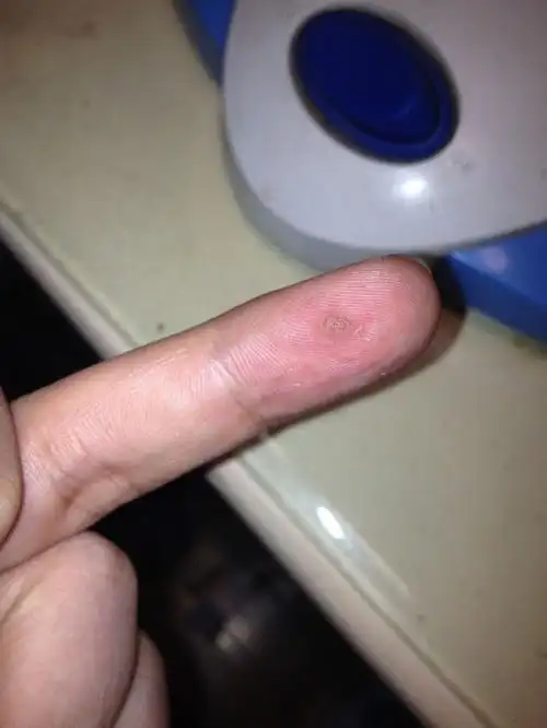 手指上长了个硬块.