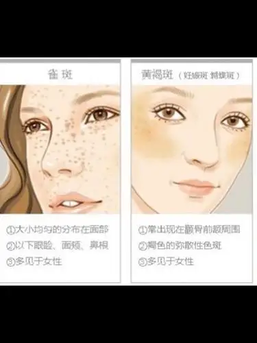 【如何分辨和治疗雀斑,黄褐斑】9990697115色斑是因皮_圈子