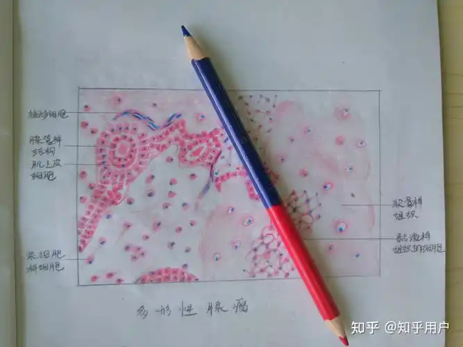 多形性腺瘤红蓝铅笔