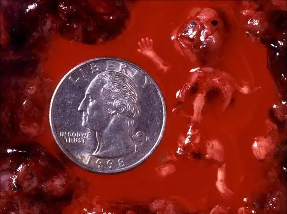 【女人一定要看】堕胎的真相(图片请慎入).