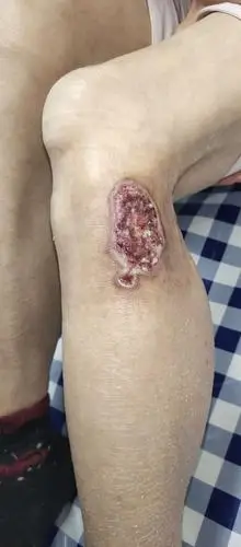 皮肤再生技术治愈艾灸3度皮肤烧伤 - 美篇