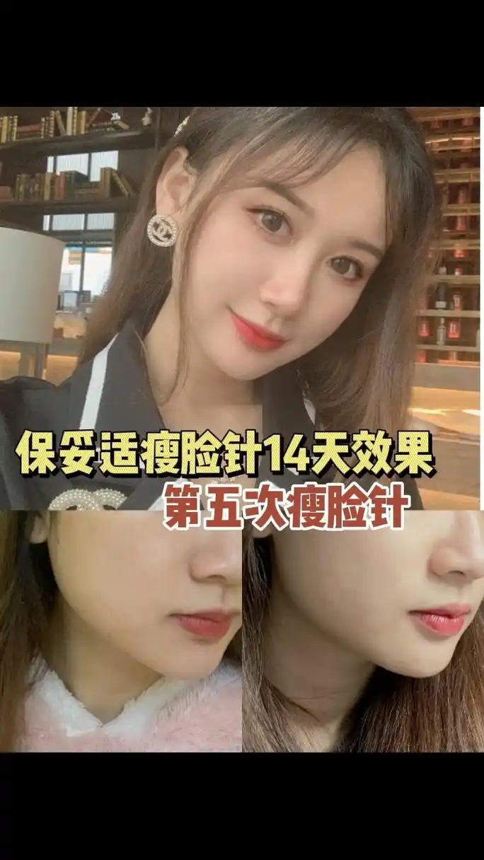 瘦脸针14天效果咬肌小了好多啊啊啊啊太有用了不要吃硬的东西就好啦这