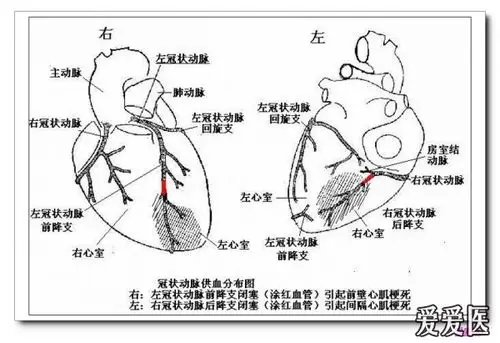 (015502-方-男-80岁-异常q波五年) 图5-36  陈旧性前壁心肌梗死伴左束
