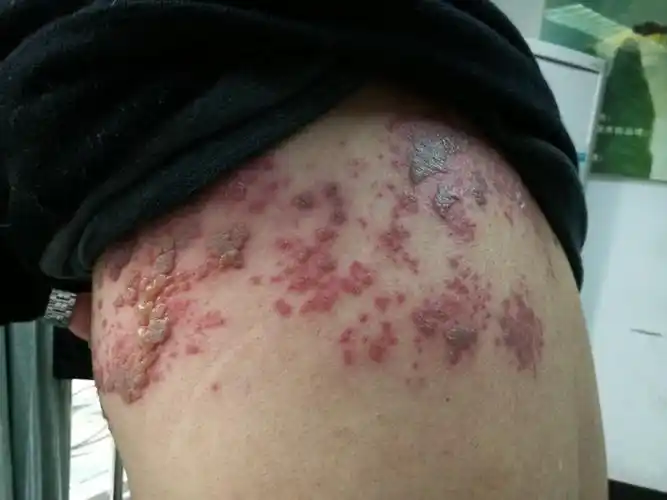 得了带状疱疹,治疗要及早 - 好大夫在线