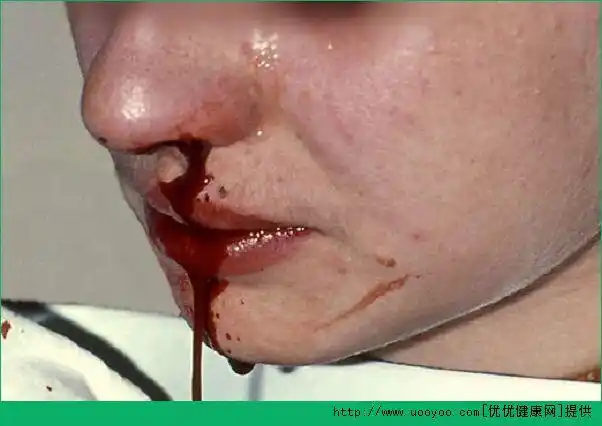 13岁孩子鼻子出血怎么办?13岁流鼻血怎么办?[多图]