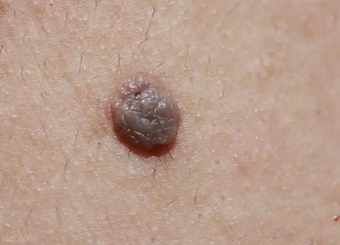 感染hpv者有5个特征,接触也能传染,要接种疫苗别被5种谣言误导