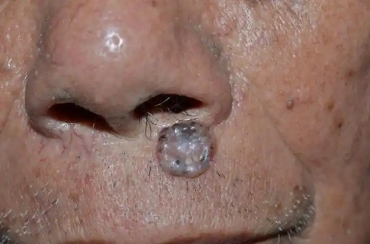 痦子图片(脸上微凸的痣) - 赤虎壹号