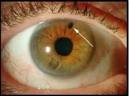 原发性闭角型青光眼周边虹膜切除手术前后超声生物测量比较
