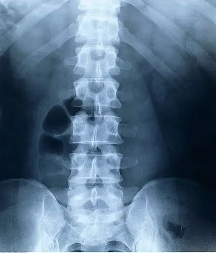 x光,脊椎