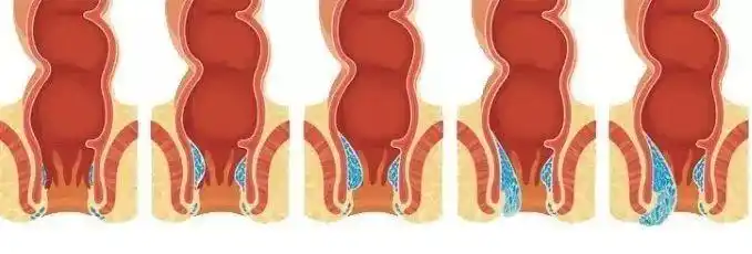 为什么女性更容易得痔疮这三个特殊时期是关键