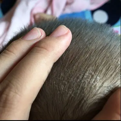 宝宝头皮最近起这样的东西 大概发现有1个多月了 急