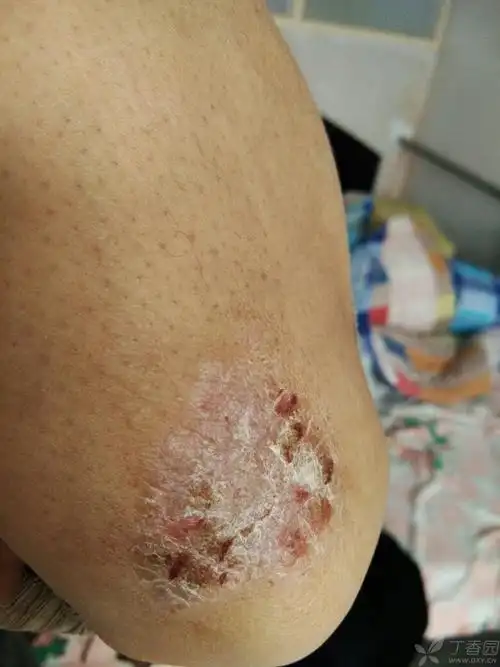 基层小大夫,家里老父亲,皮肤顽固癣,**各位大神指导. [病例帖]