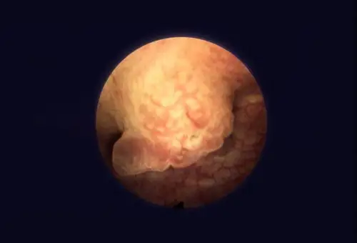 右侧图片红色箭头处为膀胱颈附件的非肌层浸润性膀胱肿瘤.