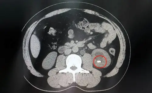 左侧输尿管下段结石左肾结石膀胱结石患者外院手术失败特来龙蟠无创取