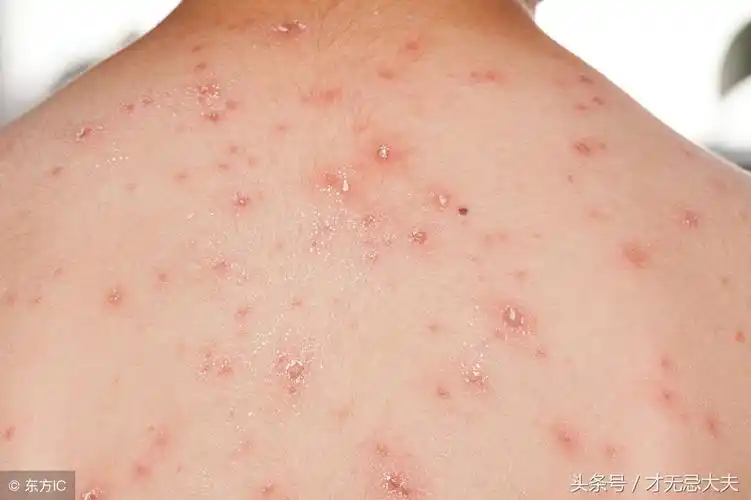 成人水痘症状图片(水痘) - 赤虎壹号