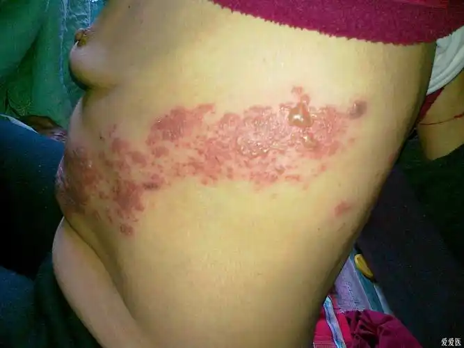 带状疱疹怎么治啊?