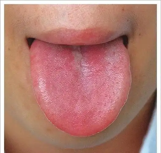 中医舌诊9大体质舌诊图赶紧看看你属于哪种