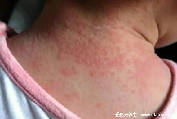 婴儿痱子症状图片,三种症状的痱子和湿疹一定要区分开