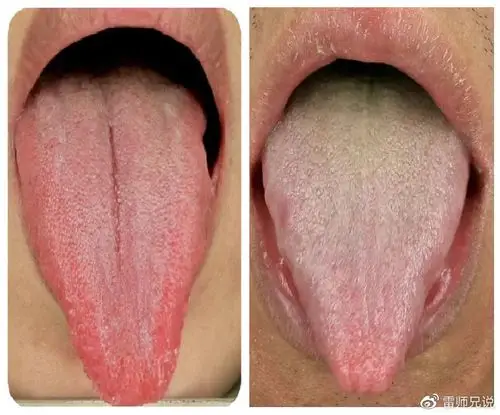 我发现很多患者是这样舌头尖尖的形状,这种舌头形状代表什么呢?