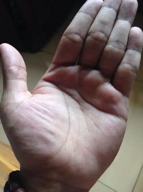 男人手掌肥厚(男人手掌肥厚怎么办)