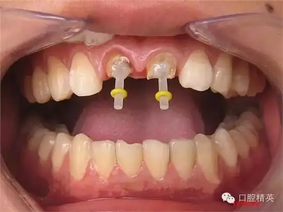 不拔牙根:桩核冠镶复病例