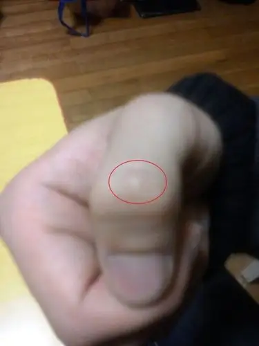 【大拇指关节处骨头突起】