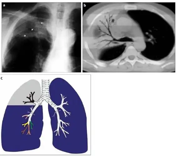 右上肺叶因放射性肺炎导致的实变伴空气支气管征.