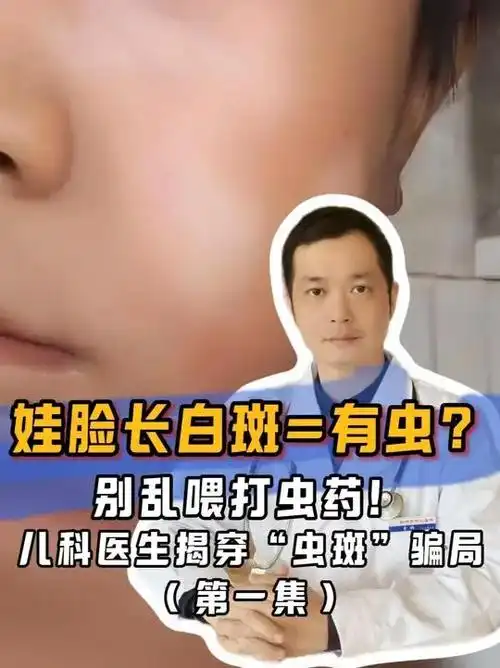 娃脸上有白斑怀疑有虫?儿科医生提醒您别乱喂打虫药