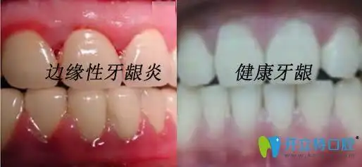牙龈炎症状和图片以及边缘性牙龈炎的治疗方法都在这里