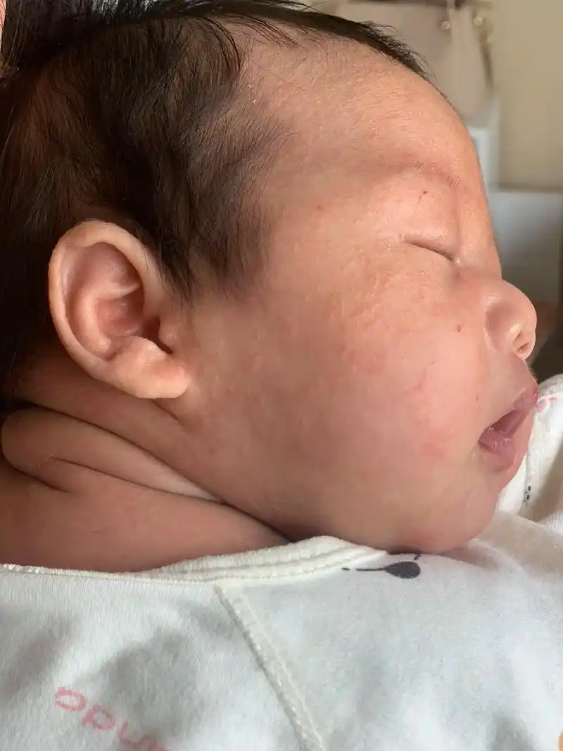 人类幼崽 #小奶娃 #热疹 #宝宝脸上起小疙瘩怎么办 #疹子