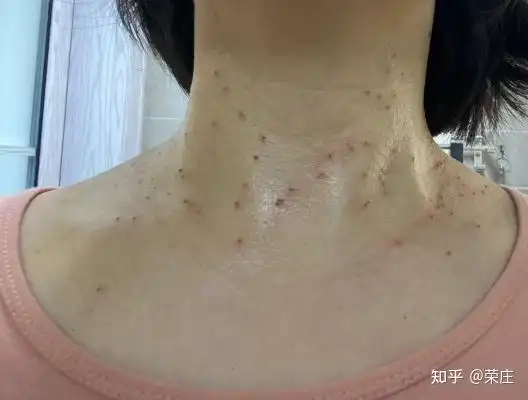 丝状疣治疗记录 - 知乎