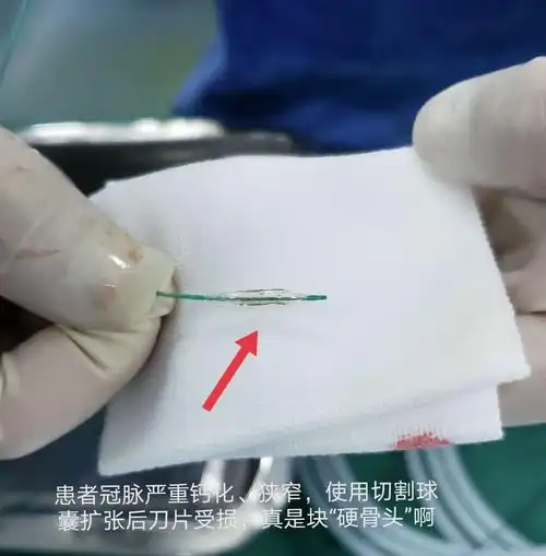 我们使用切割球囊扩张冠脉严重钙化,狭窄部位,结果不满意