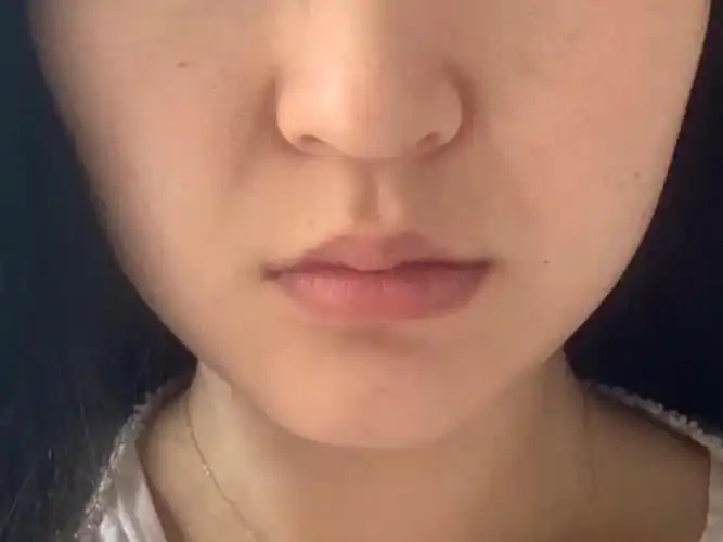我鼻基底凹陷,连带着我的法令纹也特别的明显,即使是_圈子-新氧美容
