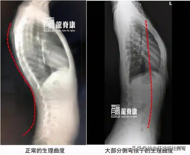 大部分矫正脊柱侧凸畸形的治疗原则是什么?(图)-宛西生活网