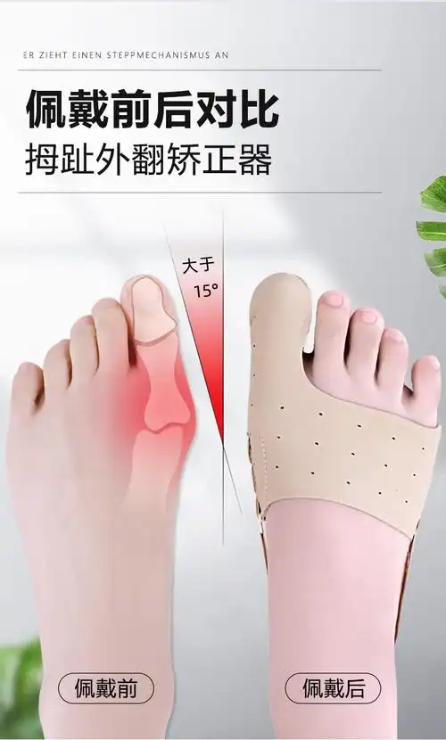 小米mi生态同款妙灵安日本大母脚趾矫正器拇指外翻男女士纠正大脚骨