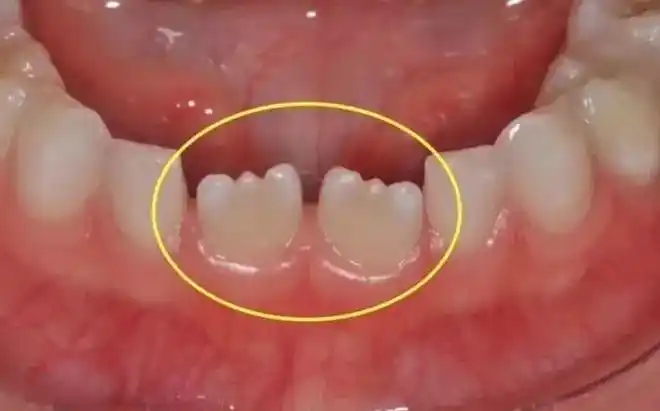 乳牙脱落,恒牙长出