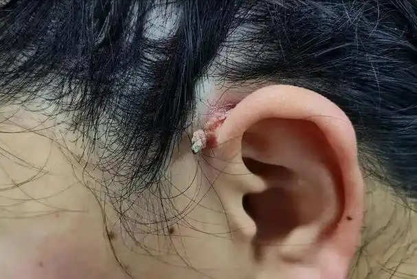 人乳头瘤病毒早期图片,人乳瘤头病毒是什么(hpv和病毒疣都啥模样)