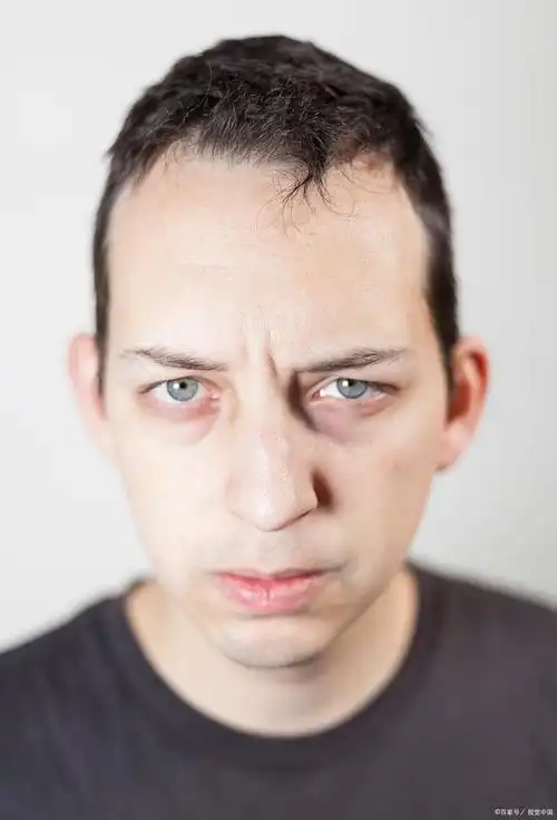 对于精神疾病患者来说,他们的眼睛往往会表现出一些特殊的表现,这些