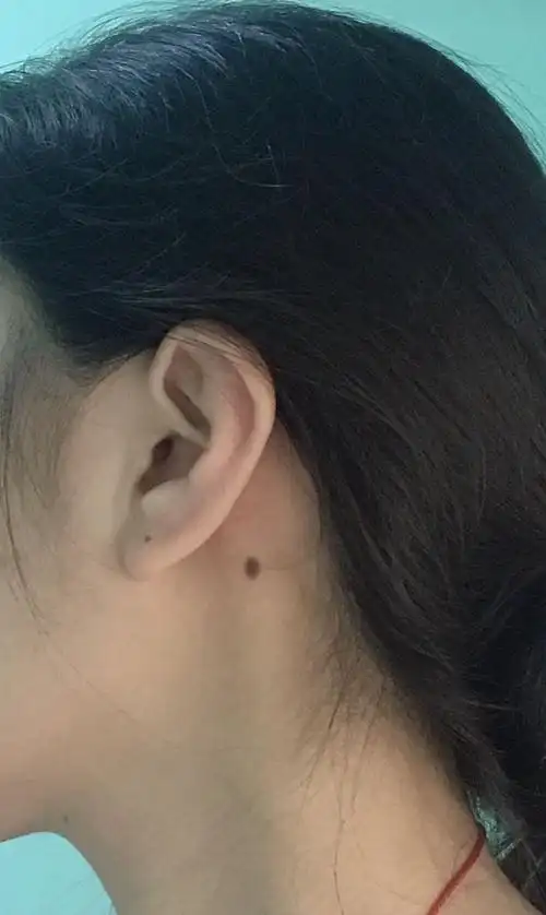 耳后有痦子是好还是不好