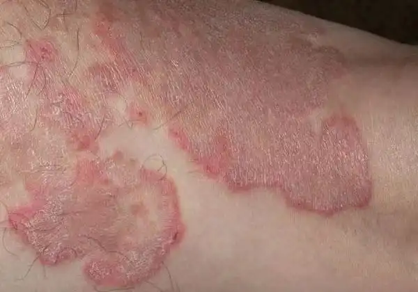 后背体股癣图片_有来医生