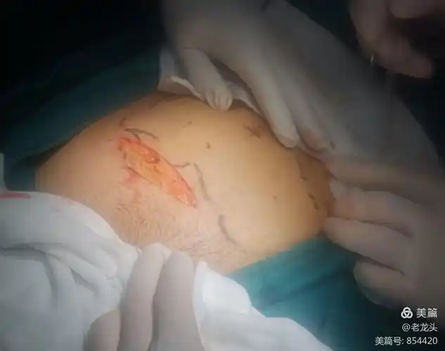 闭孔动脉损伤…腹腔镜疝手术之严重并发症