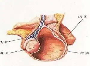 鞘膜积水鞘膜积水是指正常睾丸鞘膜囊内有少量液体(2～3ml),供滑润