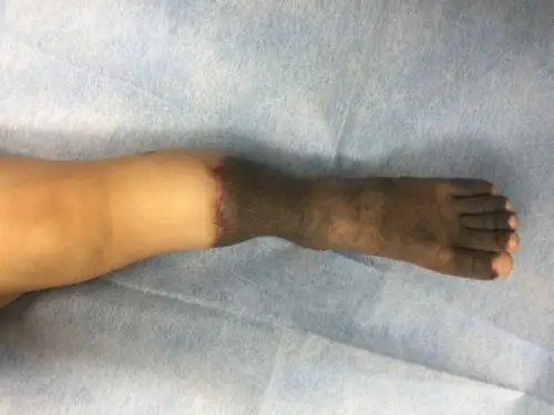 67兽皮痣是怎么治疗的为什么我们会患上兽皮痣呢