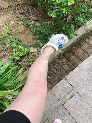 被海南蚊虫槟榔虫咬之后对抗之路